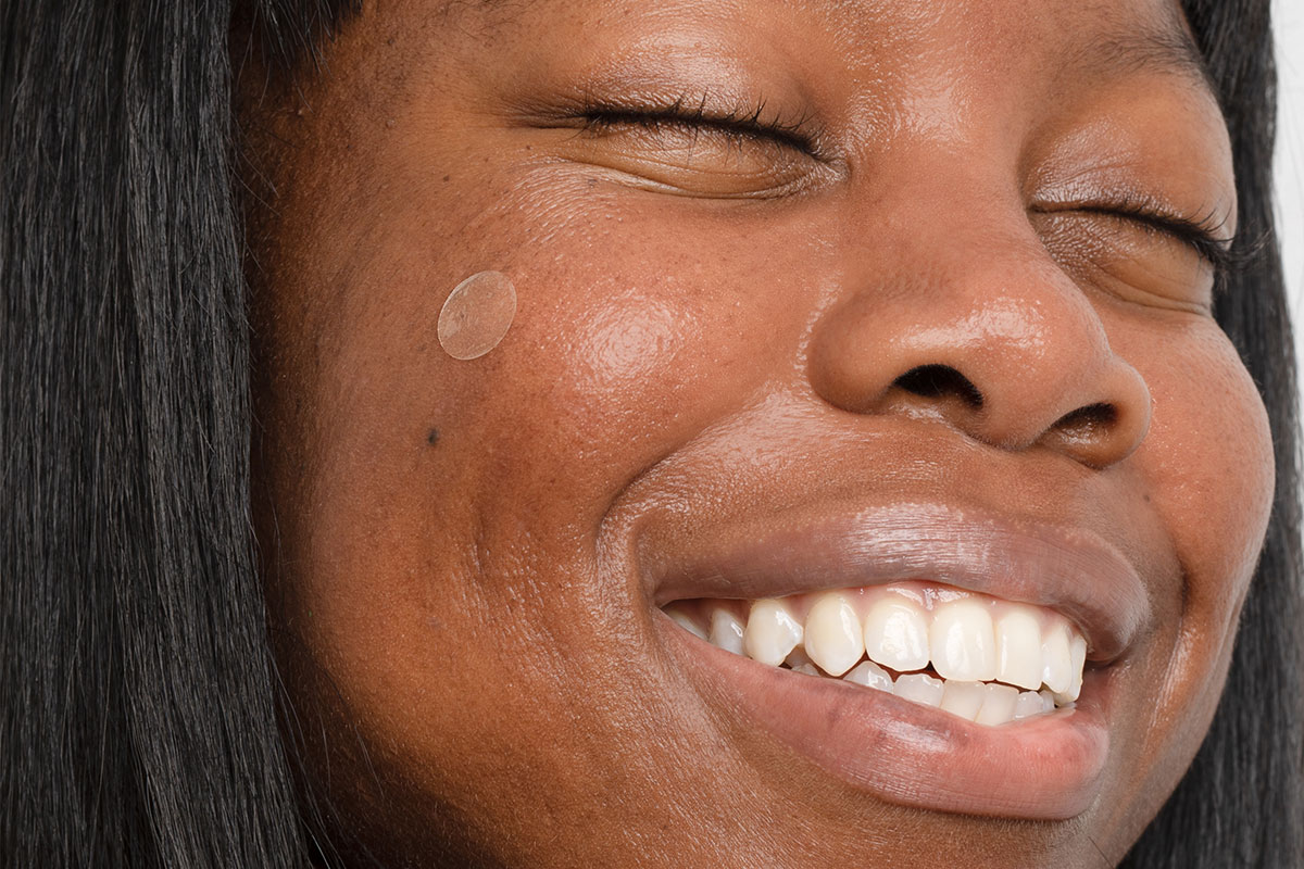 Closeup of woman smiling with emergency spot patch on cheek
