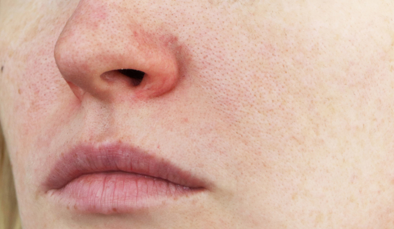 Nose with rosacea
