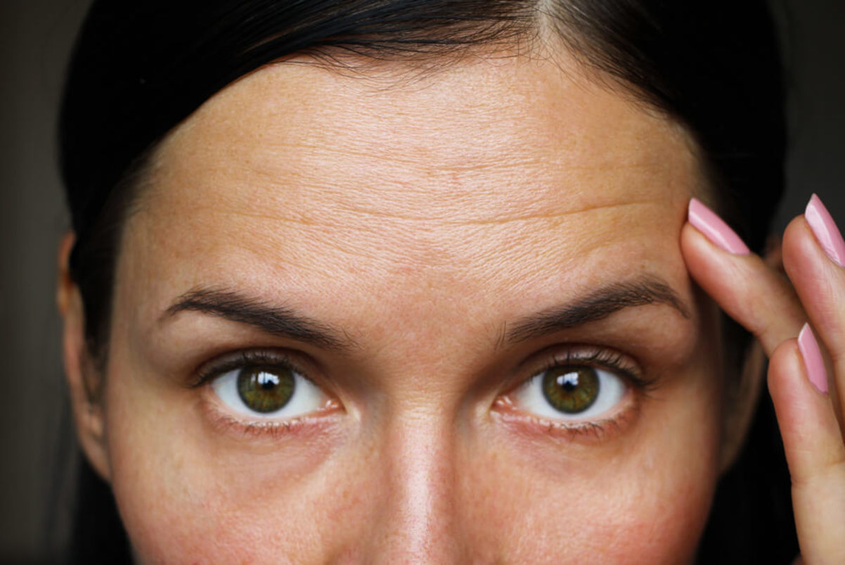 Wrinkles on the Forehead