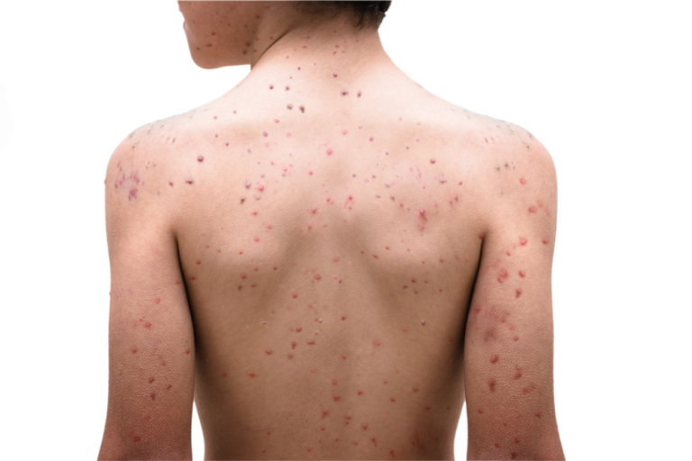 chickenpox disease on man back