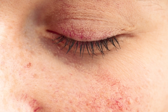 Extreme closeup view on closed eye with rosacea