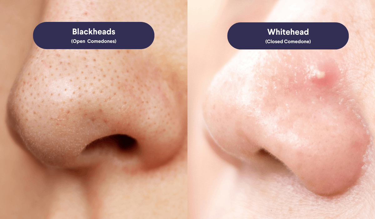 How To Treat Acne And Blackheads Like A Pro   Blackheads Vs Whiteheads 