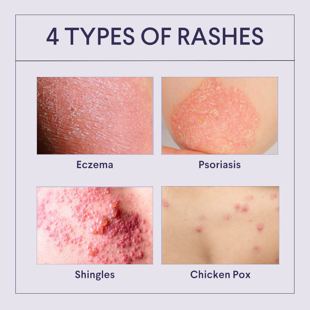 How To Help Stop A Rash From Spreading According To Skin Experts   4 Types Of Common Rashes 