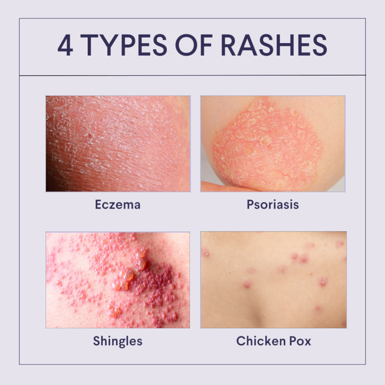 4 Types of Common Rashes