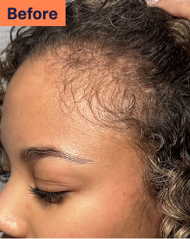 Natani Before Hair Growth