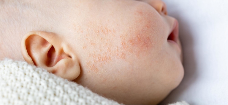 Red spots on a baby-s face