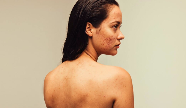 Woman with face and back acne