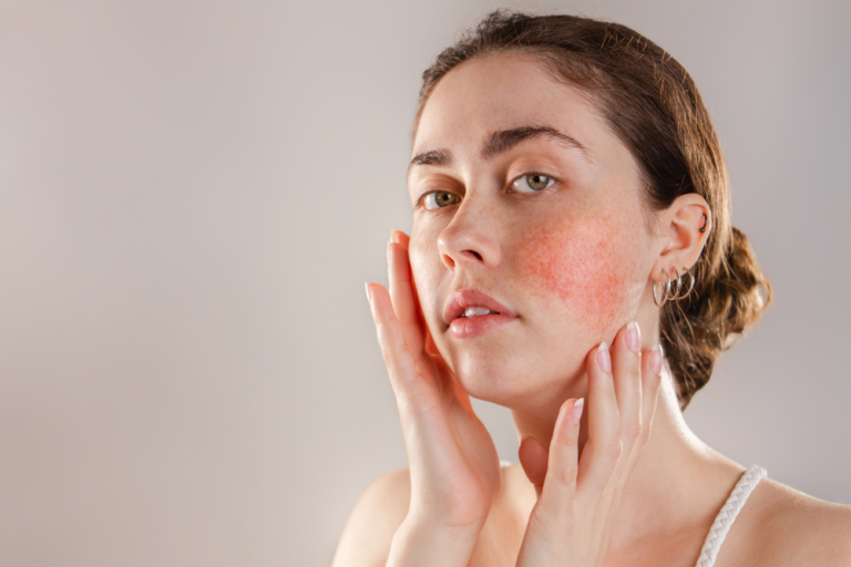 woman with red little spots on her cheeks