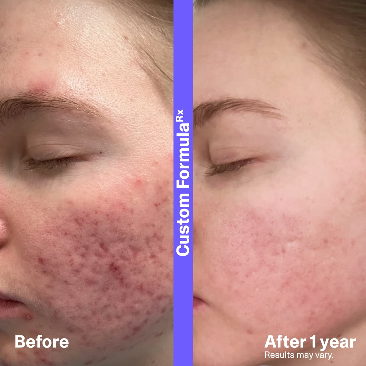 Before and after photos of real Curology patient after 1 year