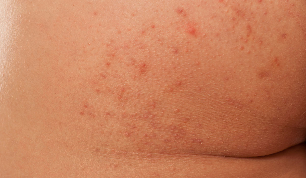 Close up image of butt acne 