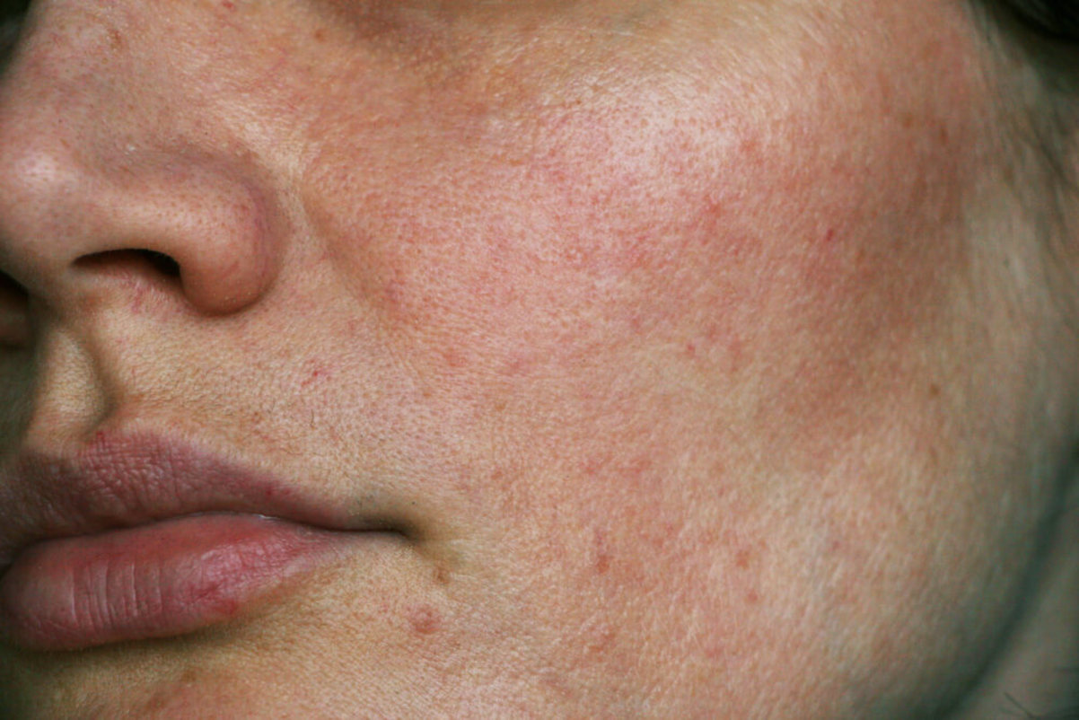 How To Use Ahas For Rosacea Curology