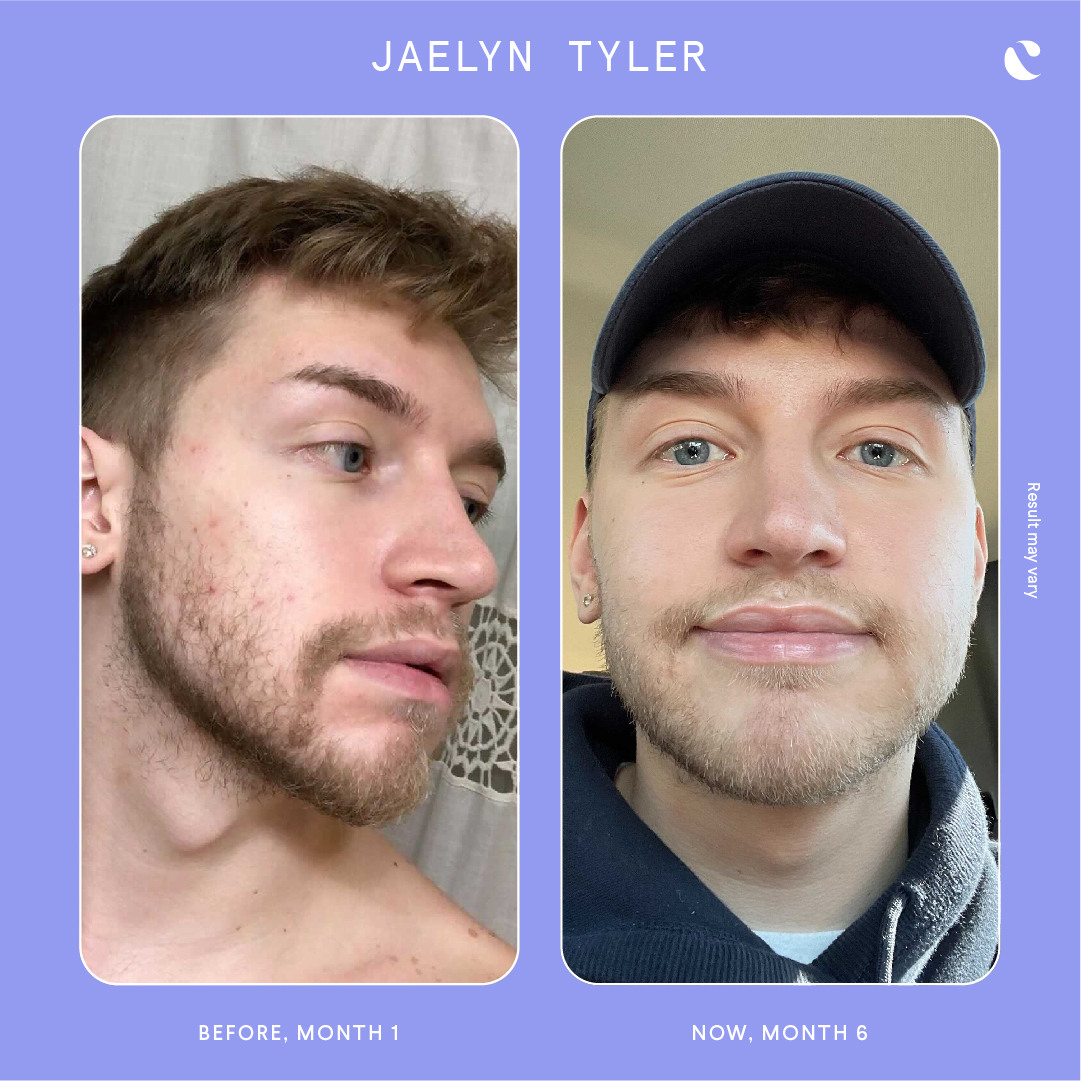Curology Review Jaelyn Before And After