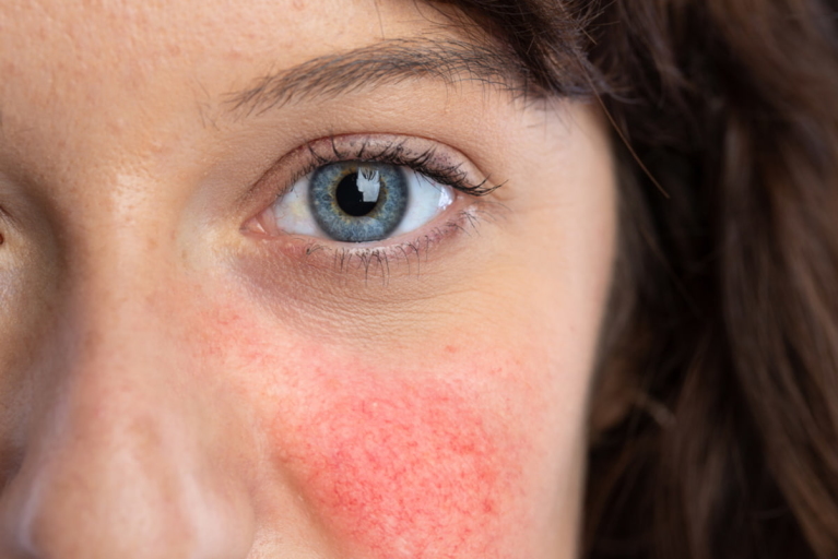 young woman with rosacea on face
