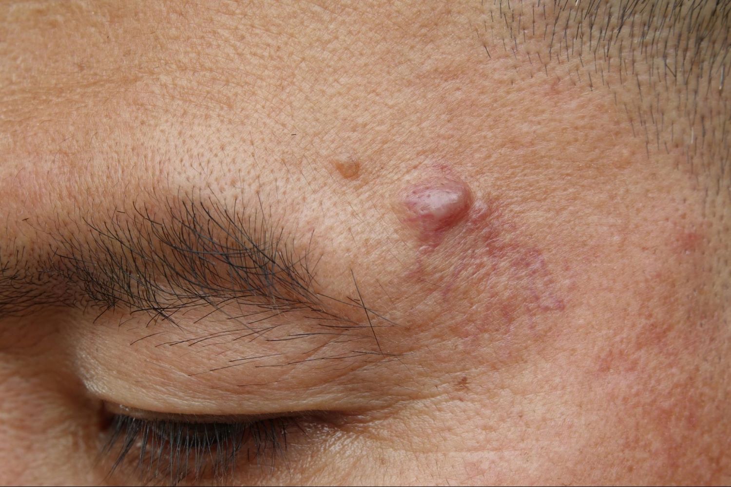 Man with Cyst Above Eyebrow