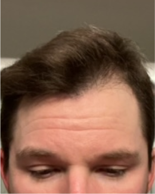 Frontal view of brunette man's hairline, after Curology use.