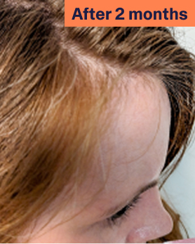 Laura After 2 Months Hair Growth