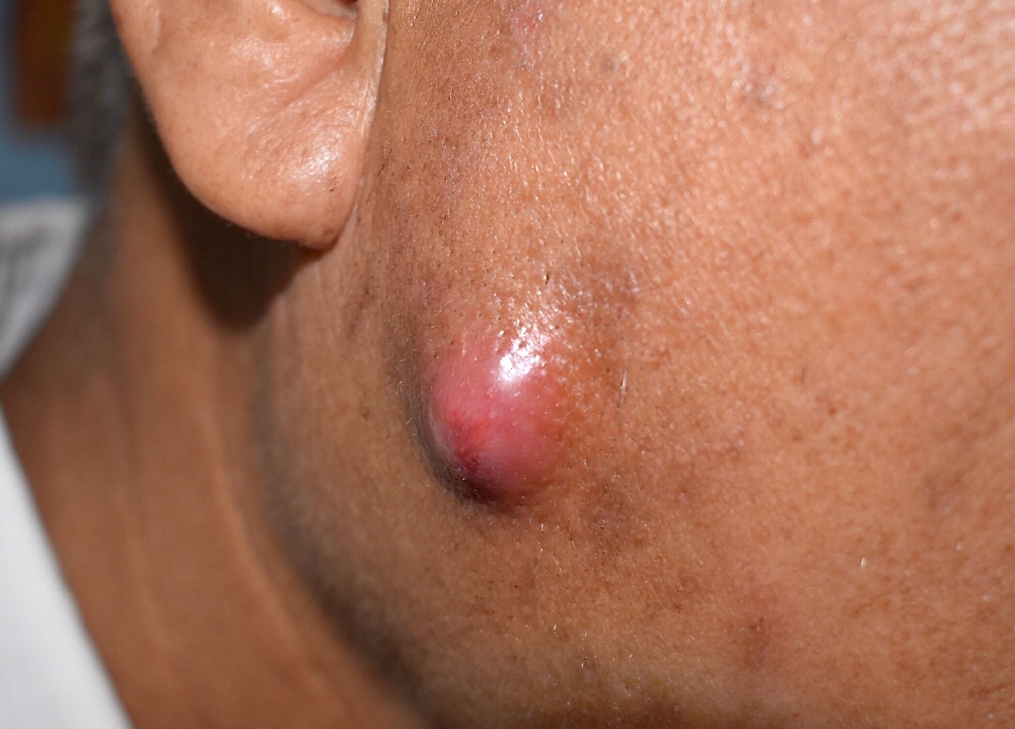 Man's Face with Abscess