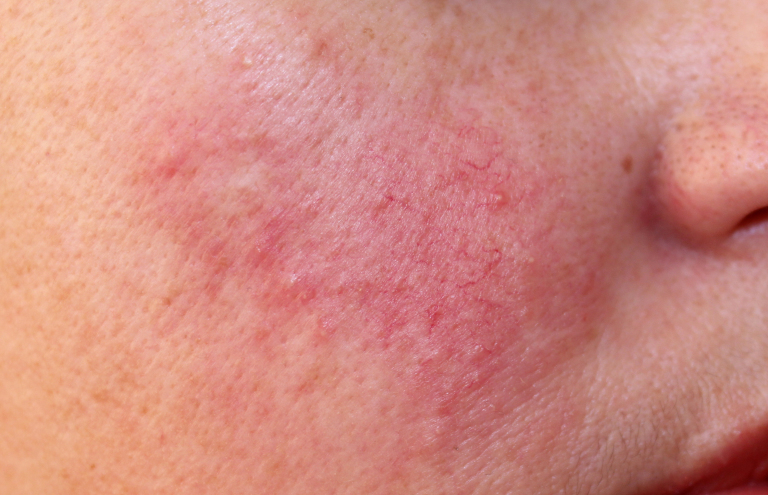Example of rosacea - rednness, broken capillaries, and small raised bumps