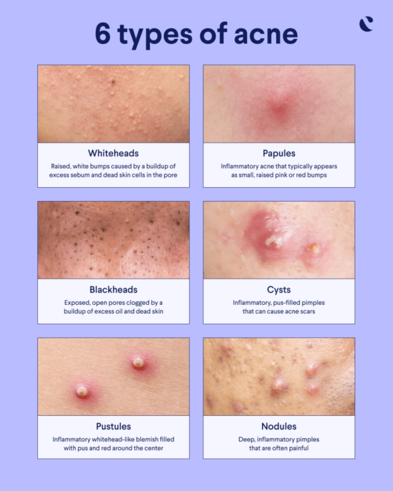 Different types of spots and how to treat acne - Dr Fox