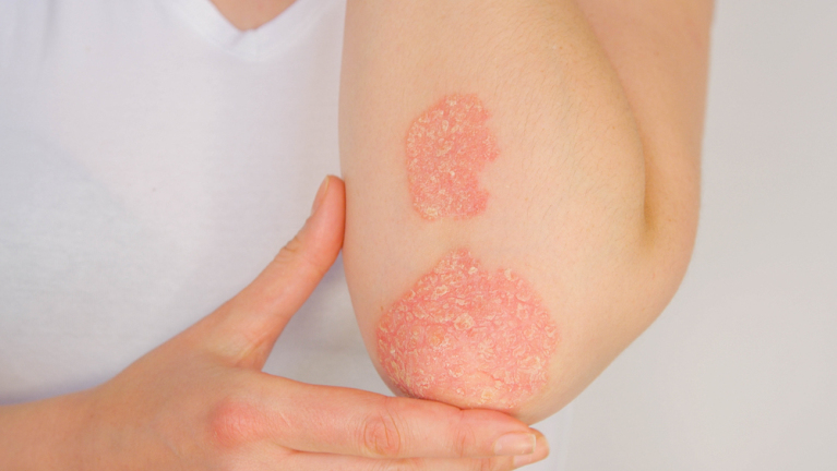Young woman suffering from psoriasis