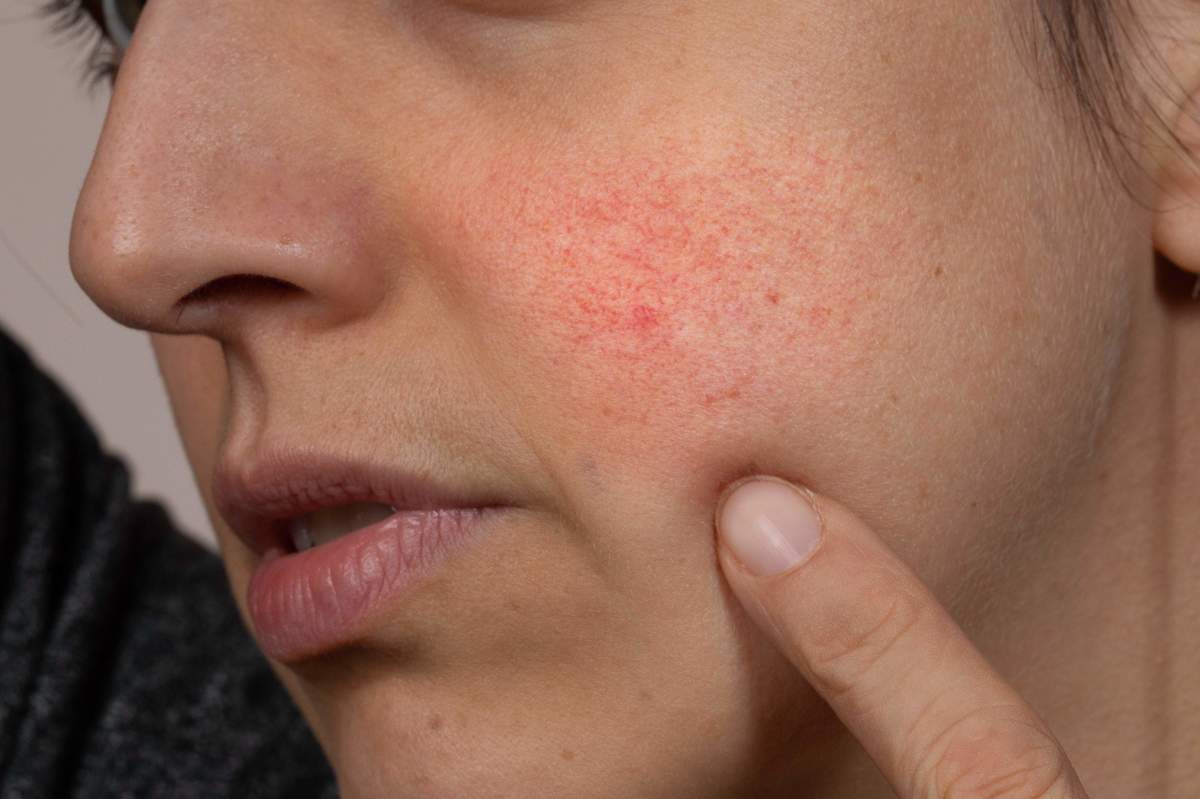 woman with symptoms of rosacea on her cheeks