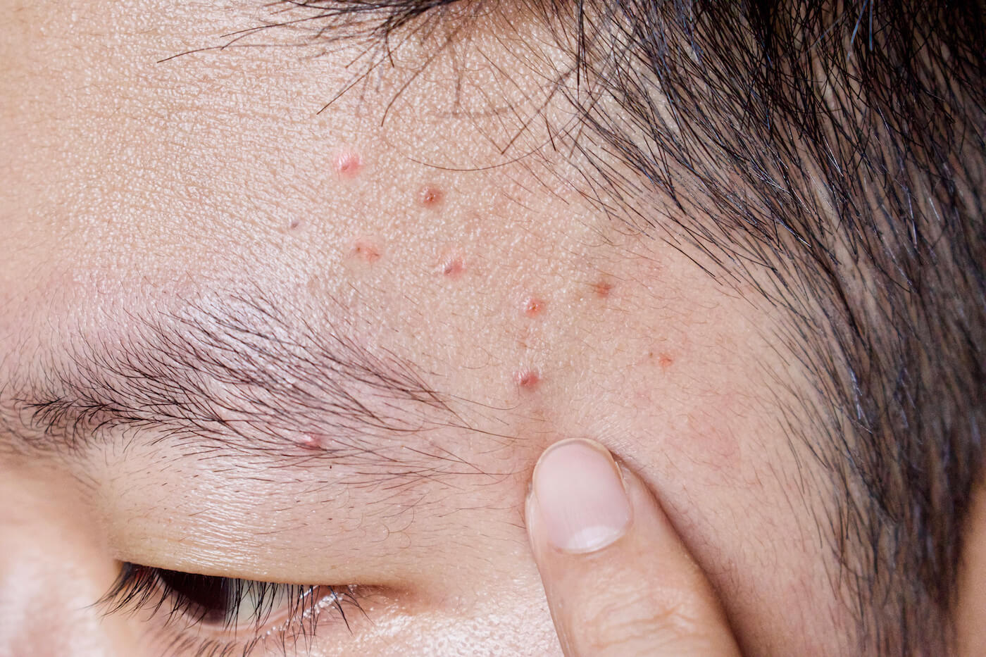 Acne Mechanica on Forehead Temple