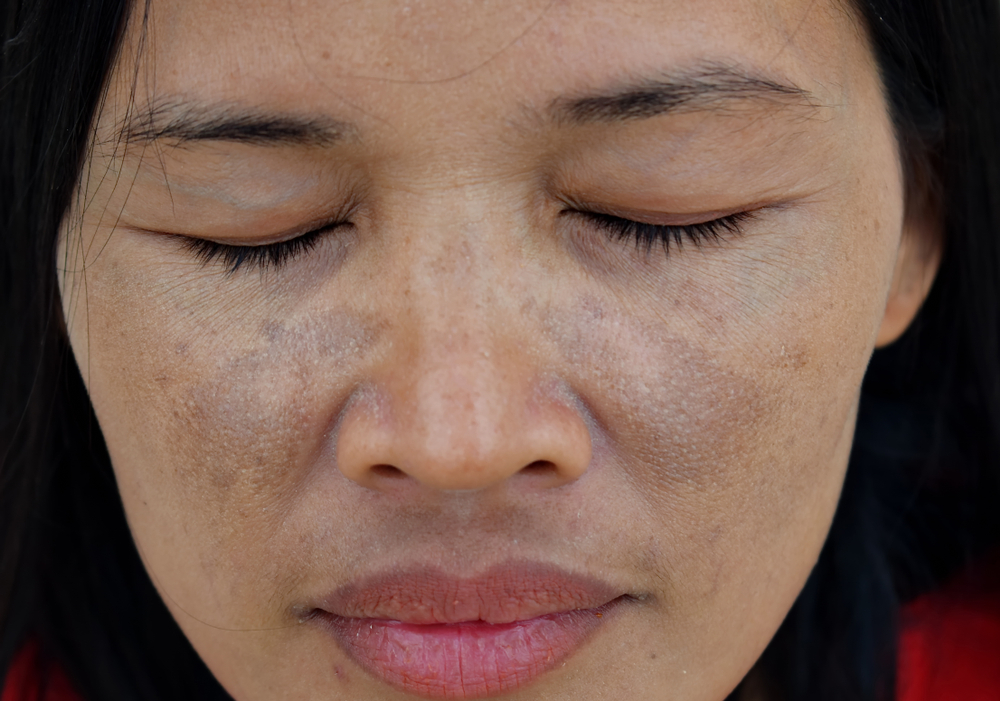 melasma dark spots on face