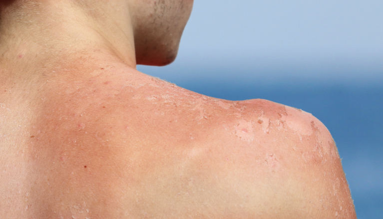 Boy reddened itchy back - Got sunburn? Here’s how to help prevent peeling