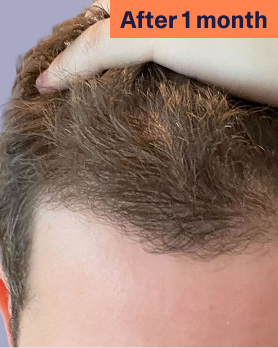 Alejandro After Hair Loss