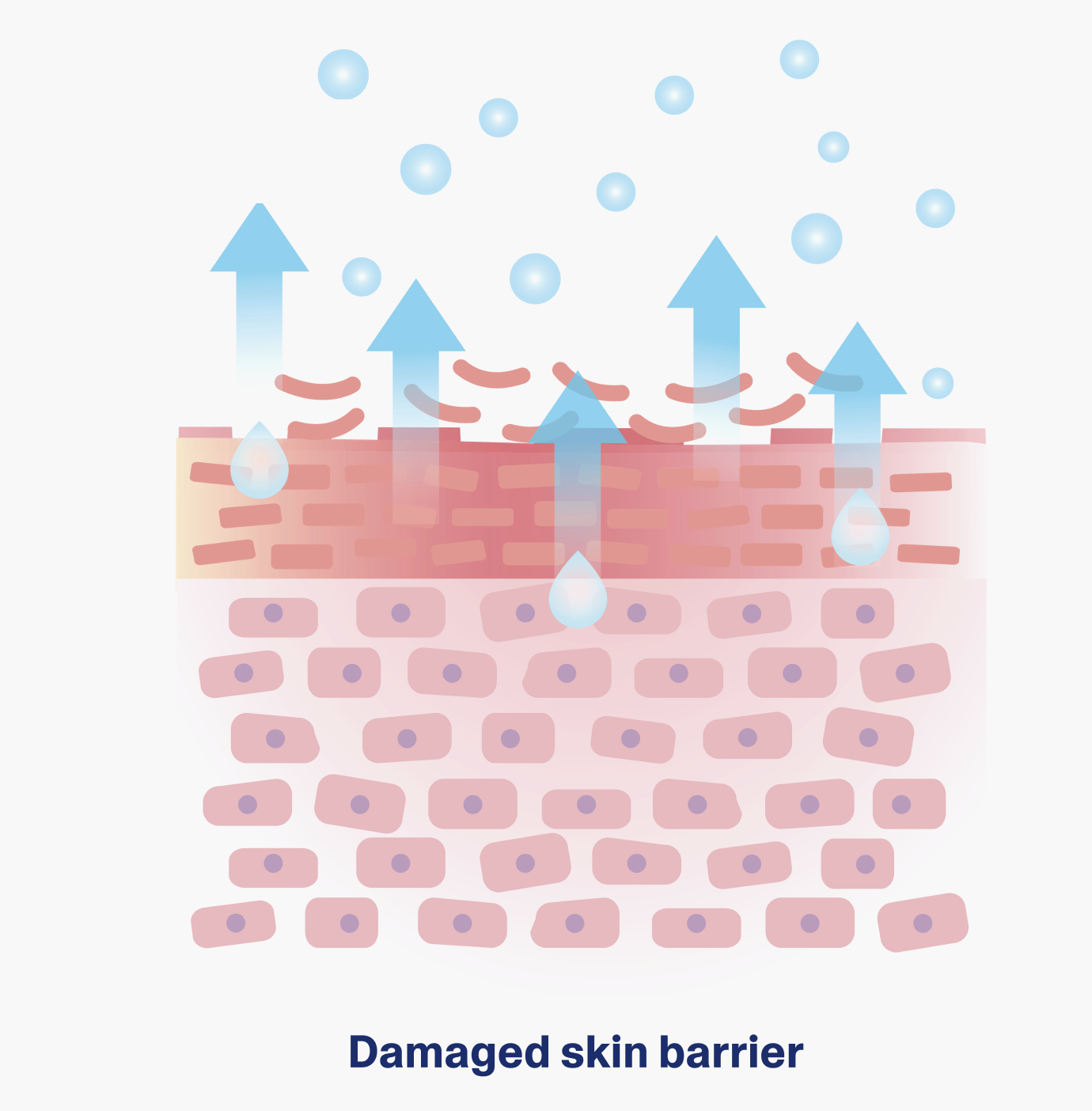 “Damaged Skin Barrier and Moisture Loss Diagram”