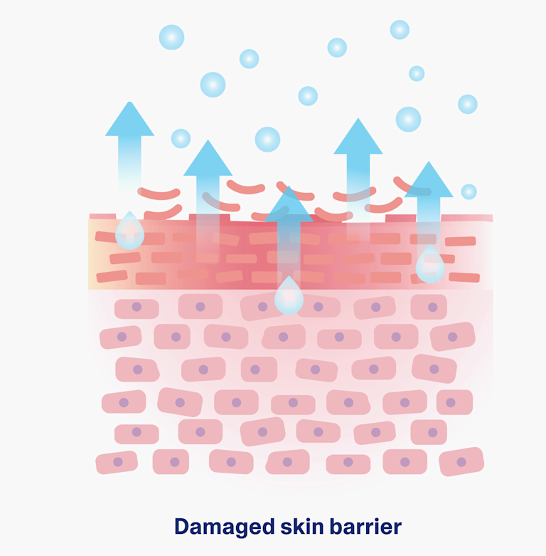 “Damaged Skin Barrier and Moisture Loss Diagram”
