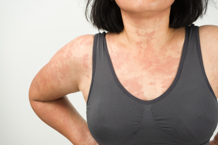 hive allergic skin reaction