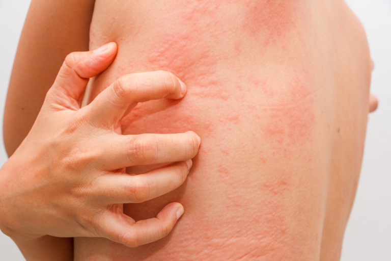 women symptoms of itchy urticaria