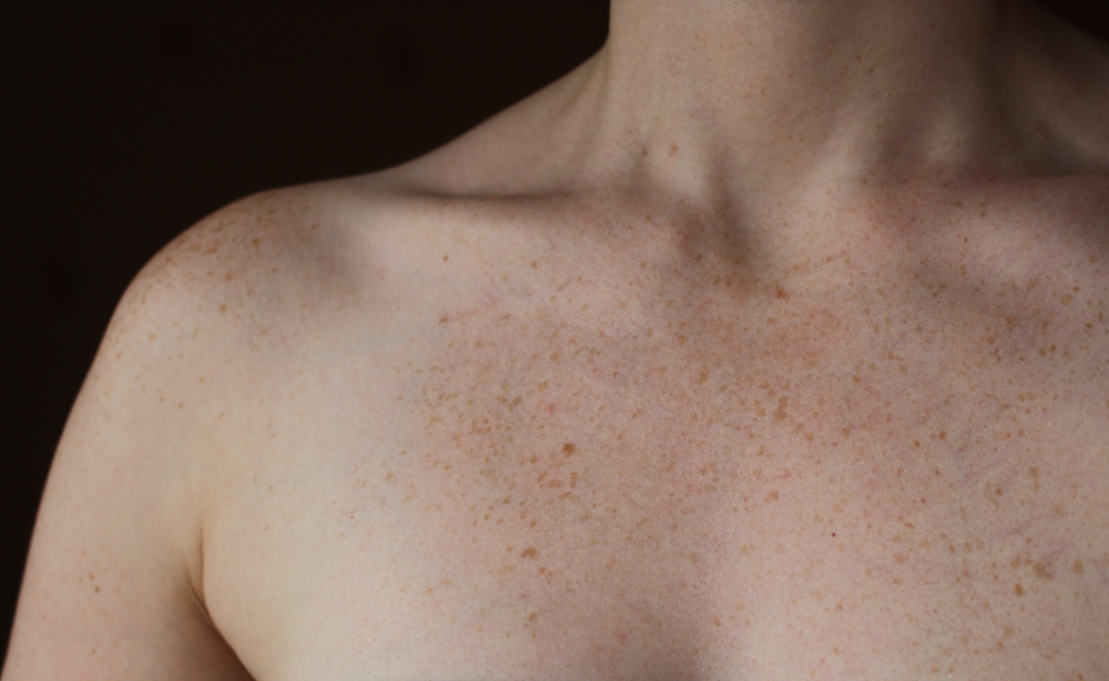 body woman freckles on chest
