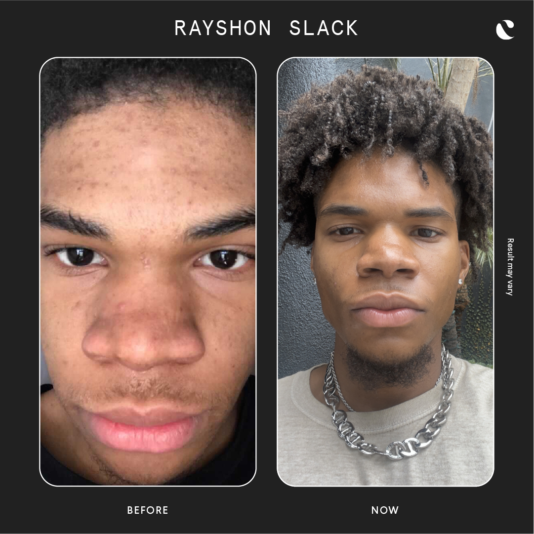 Curology Men's Before And After Results Fungal Acne