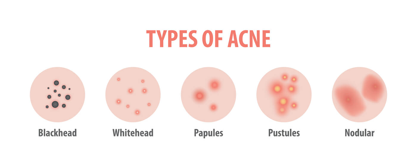 types-of-acne-info