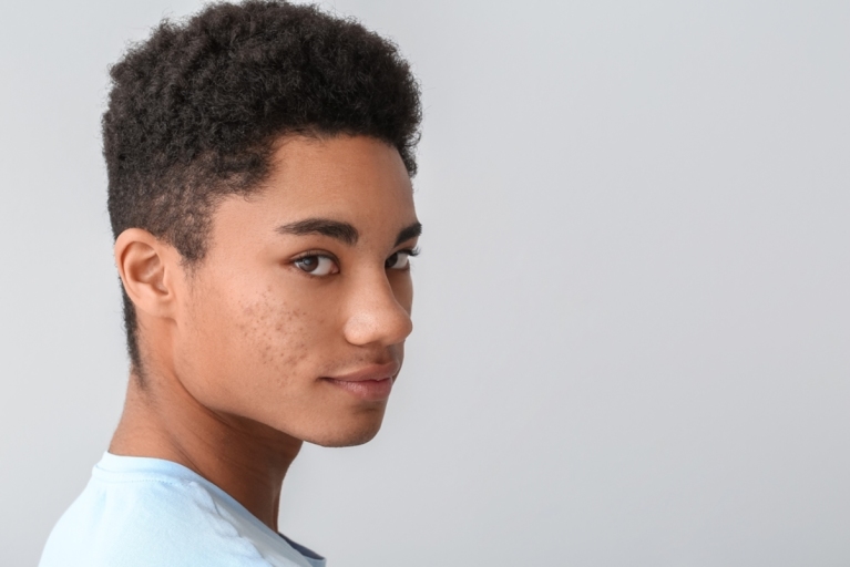 teenage boy with acne problem