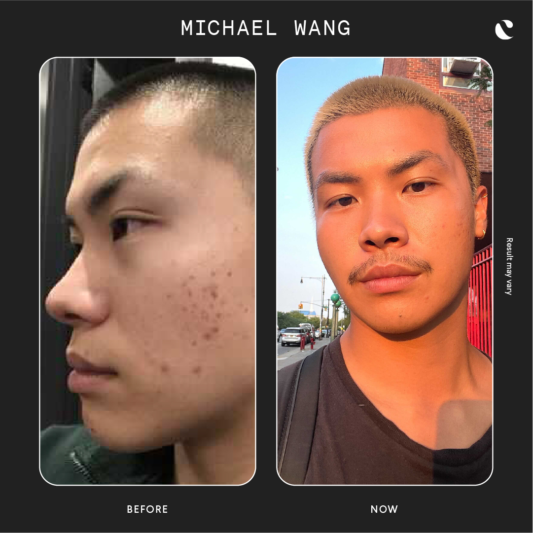 Curology Men's Before And After Results Cheek Acne Acne Scars