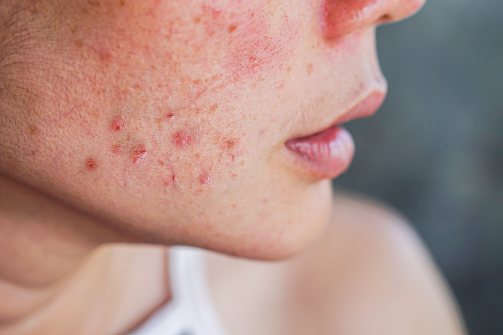 Closeup acne on woman's face rash