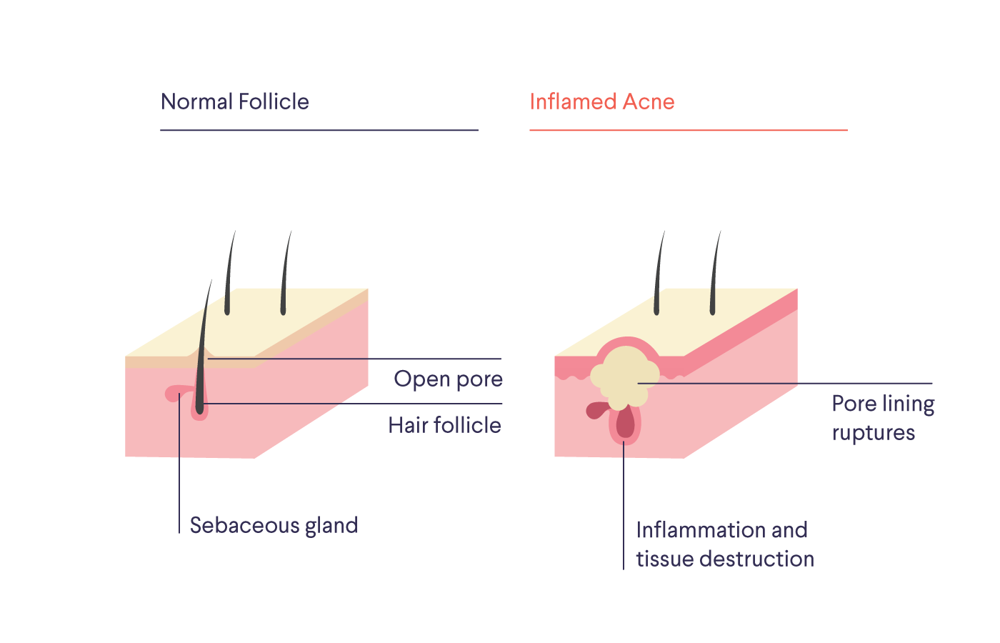 How to deal with hormonal acne - Skin 101 - Curology