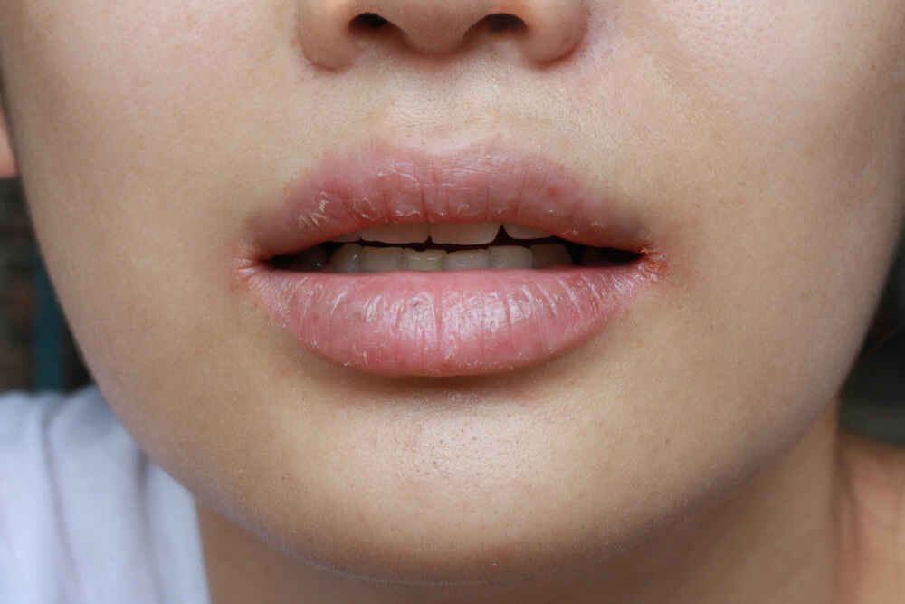 Woman with Chapped Lips