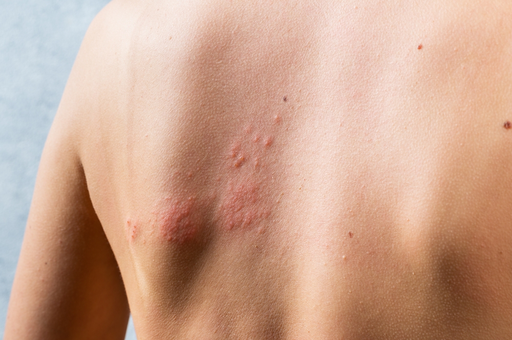 Rash shingles on skin
