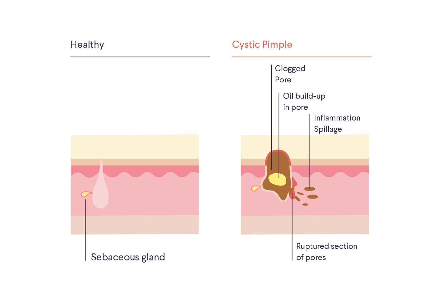 Illustration / diagram of skin with text "Healthy": "Sebaceous gland" and "Cystic Pimple": "Clogged Pore," "Oil build-up in pore," "Inflammation Spillage," "Ruptured section of pores"