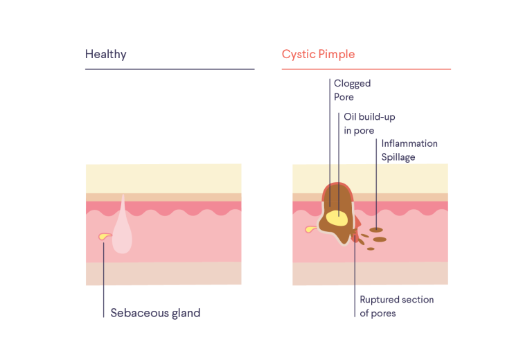 Illustration / diagram of skin with text "Healthy": "Sebaceous gland" and "Cystic Pimple": "Clogged Pore," "Oil build-up in pore," "Inflammation Spillage," "Ruptured section of pores"