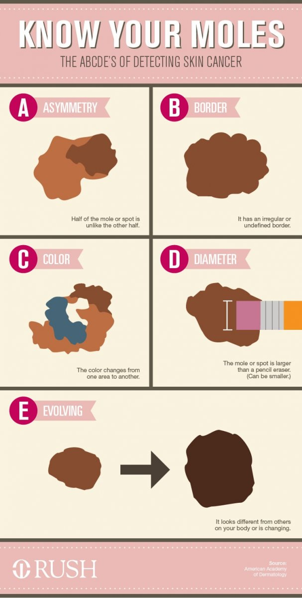 Graphic about moles and skin cancer