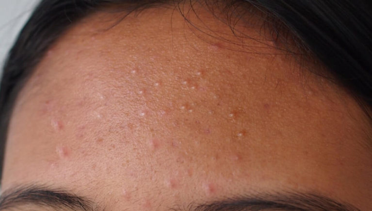 What does fungal acne look like