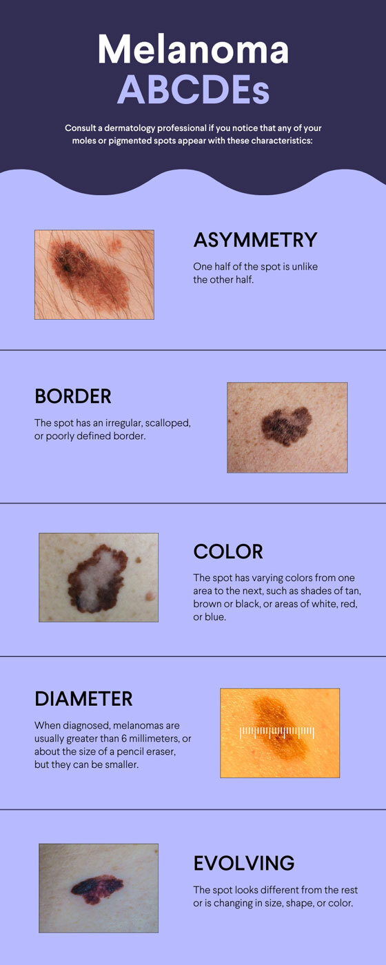 Melanoma ABCDEs infographic illustration
