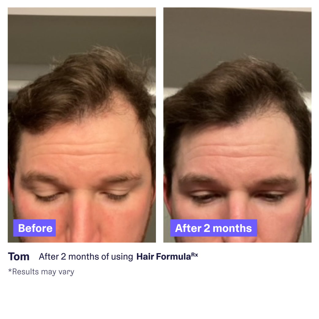 Male Hair Formula Patient Two-Month Before/After 