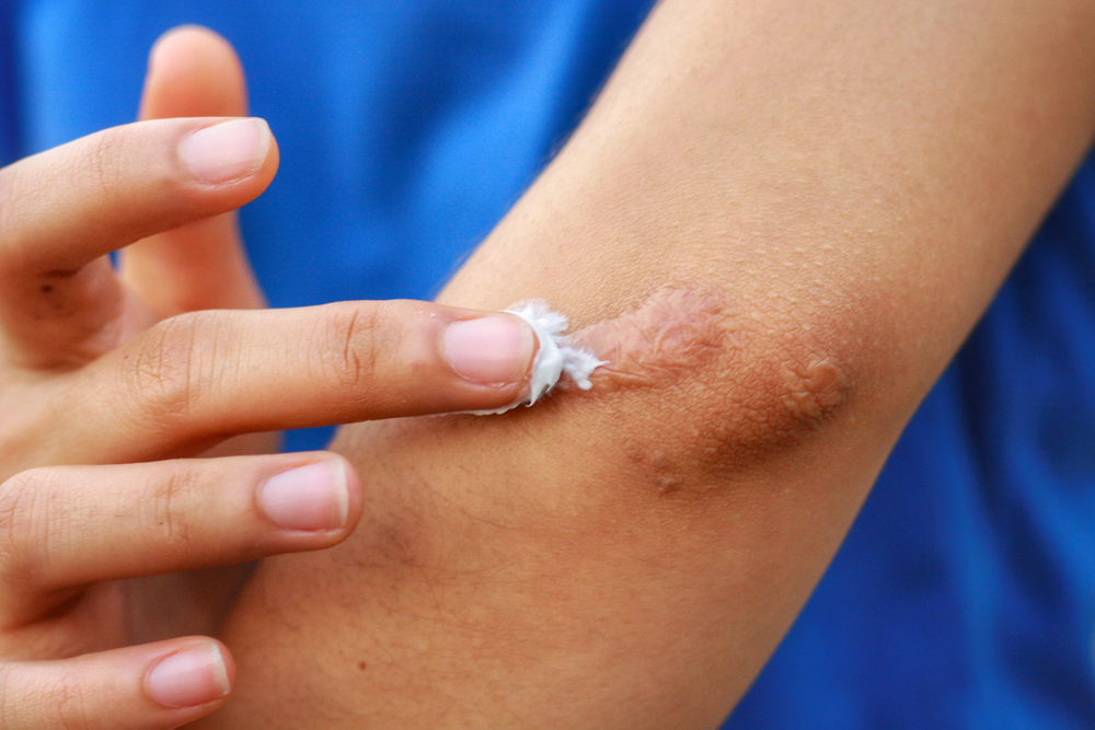 Woman applying cream on her arm