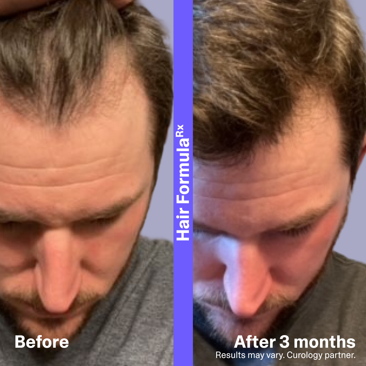 Hair Loss Before and After 3 Months 